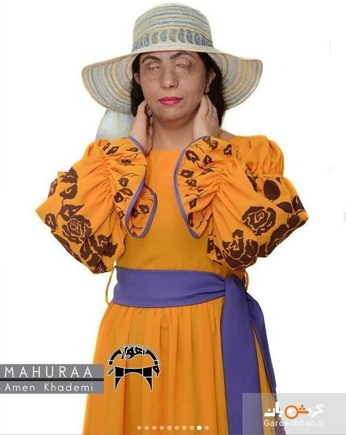 زنان قربانی اسیدپاشی مدل لباس شدند، زنان در هر شرایطی می توانند دنیا و اطراف خود را زیبا نمایند